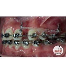 Ganci Ortodontici a Triplo Uncino da Crimpare