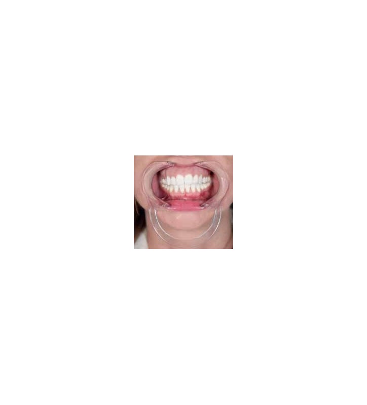 divaricatore guancia in silicone apri bocca portatile riutilizzabile per ispezione orale e sbiancamento dei denti Blu 2pcs apri bocca 