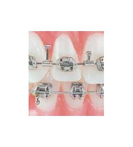 Ganci Ortodontici Bi-Direzionali da Crimpare